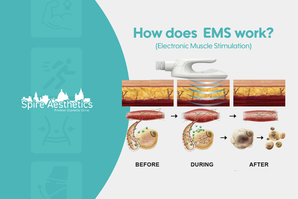 EMS treatment for post pregnancy weight loss treatment Earley