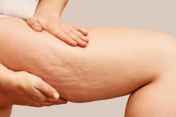 Image of woman showing leg with cellulite Earley