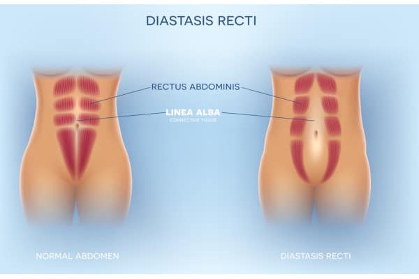 What Non-Surgical Options Are Available for Diastasis Recti Earley?