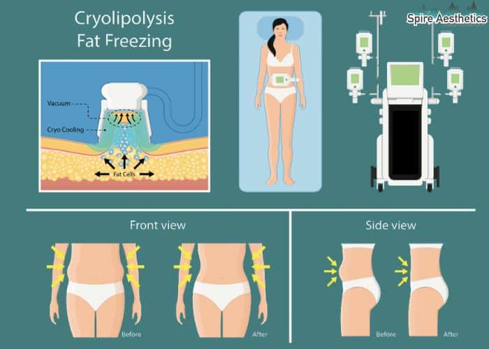 Image of diet and fat freezing combined for best results for Spire Aesthetics Earley