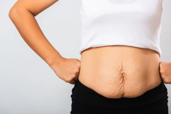 Image of a woman's stomach after weight loss with sagging skin following a gastric band Earley