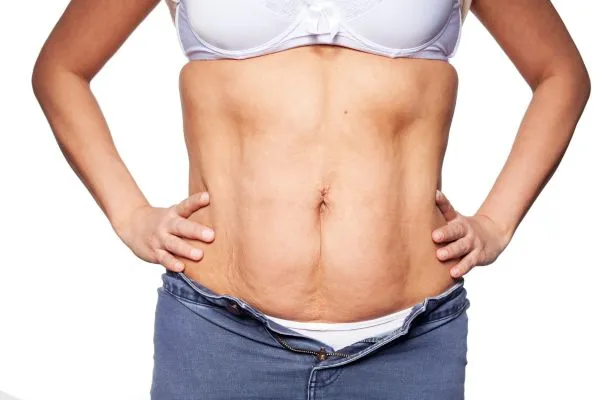 sagging skin on woman's stomach after weight loss injections Earley