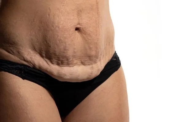 Image of womans stomach after weight loss injections Earley showing saggy skin