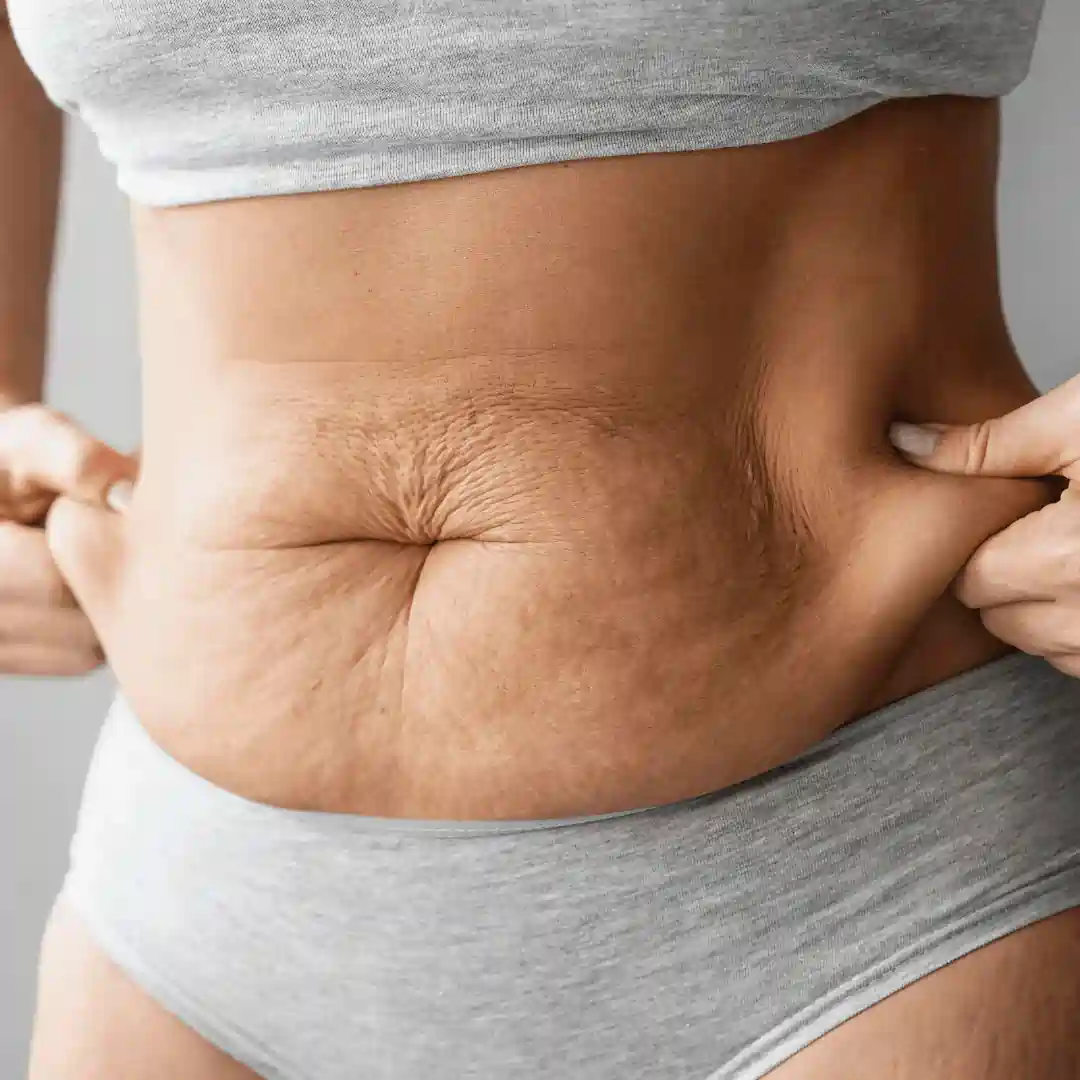 Is It Normal to Have Loose Skin After Pregnancy Earley?