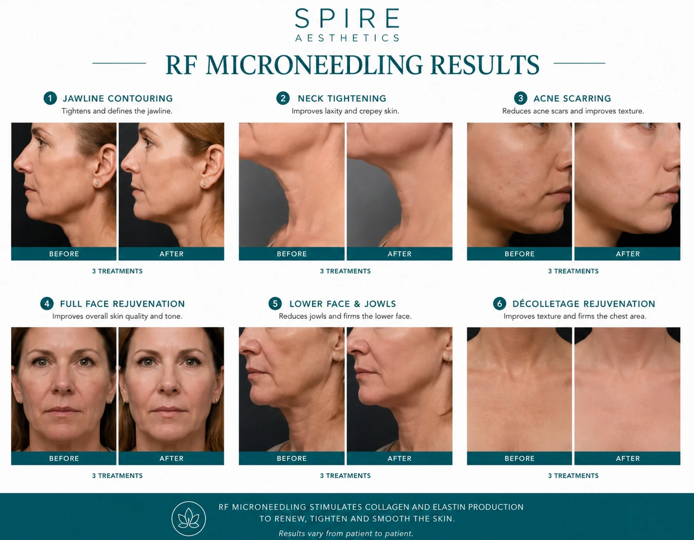 RF Microneedling Skin tightening Earley results