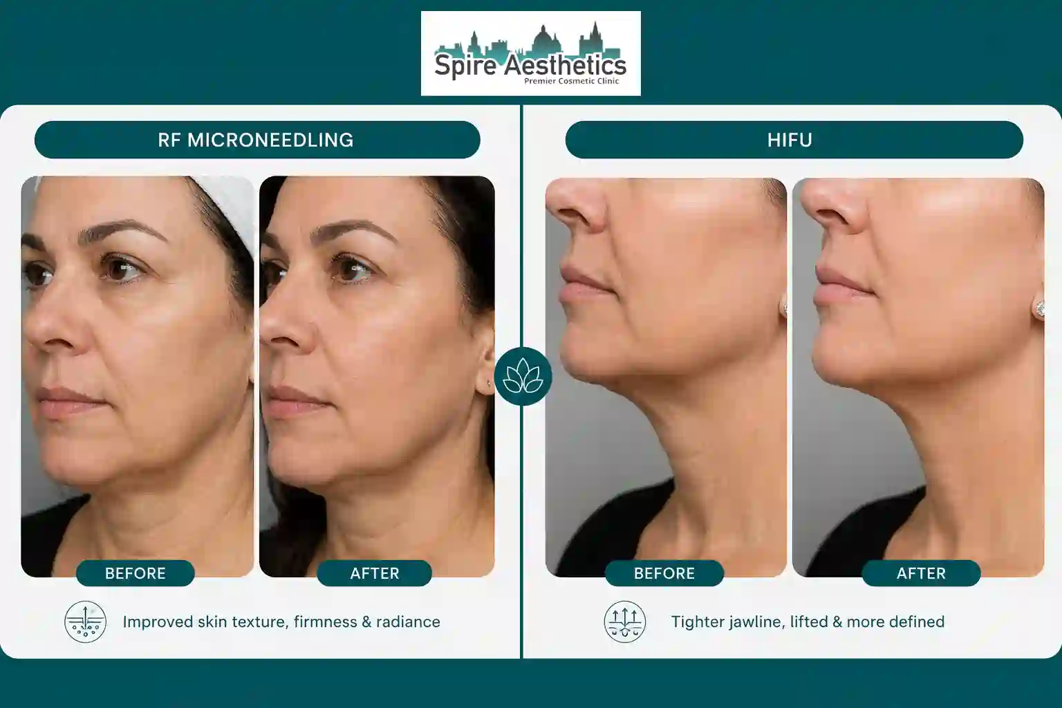 Can RF Microneedling and HIFU Be Combined Earley?