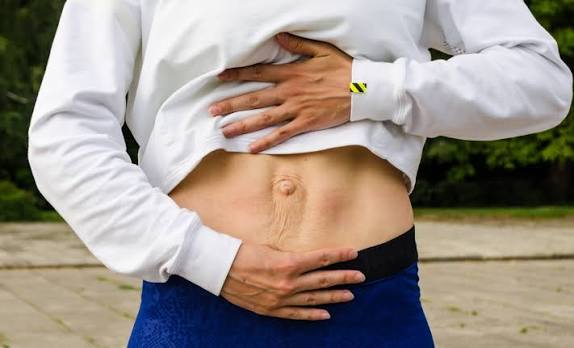 When Could Diastasis Recti Be the Missing Piece of the Puzzle Earley?